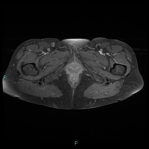 File:Bilateral ovarian fibroma (Radiopaedia 44568-48293 Axial T1 C+ fat sat 30).jpg