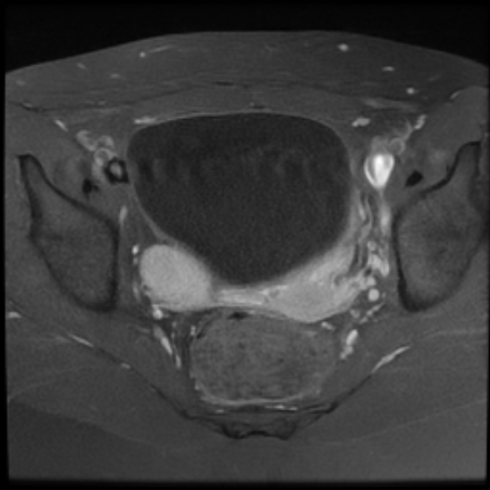 File:Bilateral ovarian fibrothecomas - adolescent (Radiopaedia 86604-102707 Axial T1 C+ fat sat 18).jpg