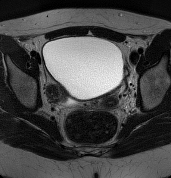 File:Bilateral ovarian fibrothecomas - adolescent (Radiopaedia 86604-102707 Axial T2 27).jpg