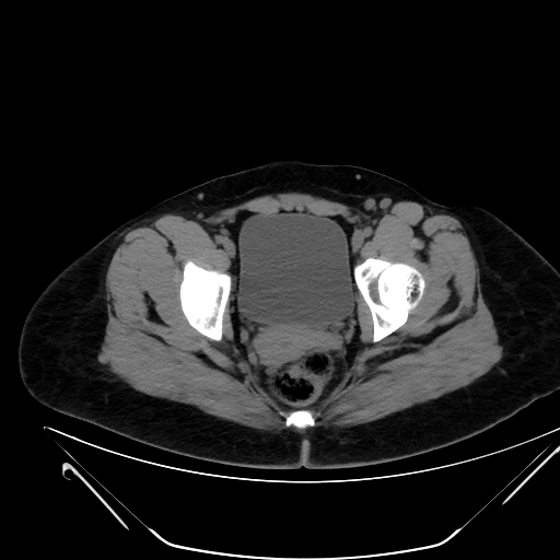 Bilateral ovarian mature cystic teratomas (Radiopaedia 79373-92457 Axial non-contrast 78).jpg