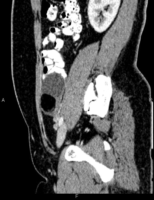 Bilateral ovarian teratoma (Radiopaedia 83131-97503 D 45).jpg
