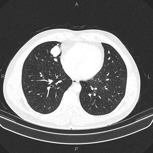 File:Bilateral pulmonary AVM (Radiopaedia 83134-97505 Axial lung window 49).jpg