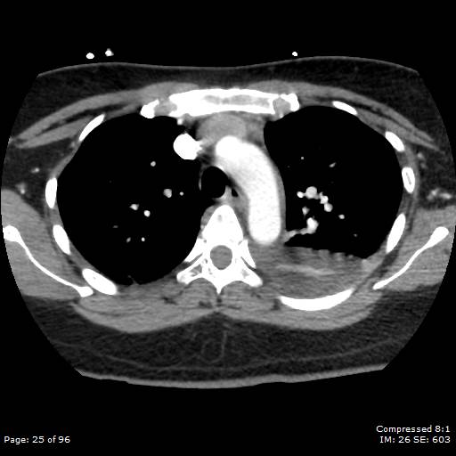 Bilateral pulmonary emboli with Hampton hump sign (Radiopaedia 54070-60246 Axial C+ CTPA 22).jpg
