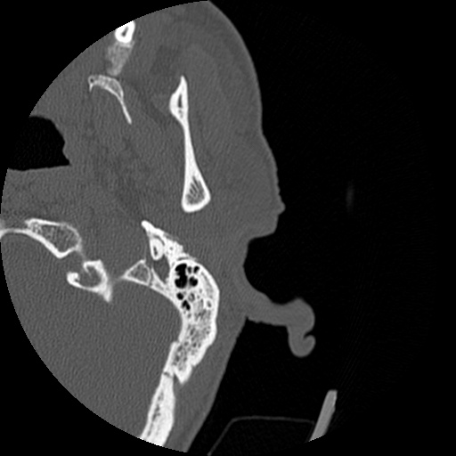 Bilateral temporal bone fractures (Radiopaedia 29482-29970 D 10).jpg
