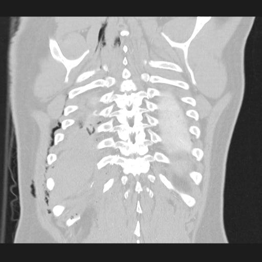 Bilateral traumatic renovascular injury (Radiopaedia 32051-32995 Coronal lung window 68).jpg