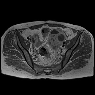 Bilateral tubo-ovarian abscesses (Radiopaedia 58635-65829 Axial T1 C+ 21).jpg