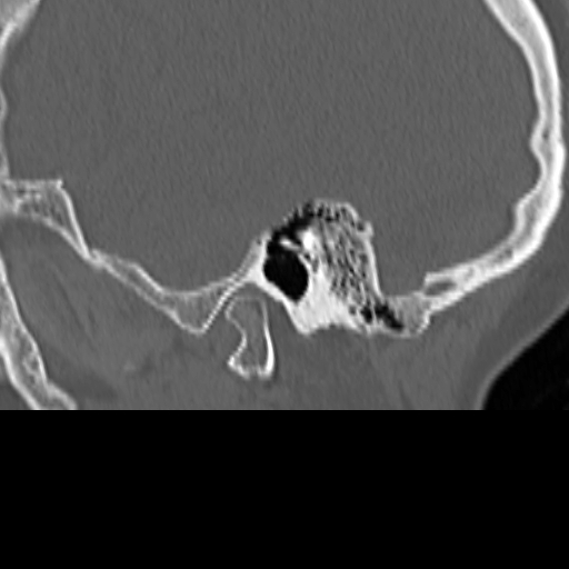 File:Bilateral tympanoplasty (Radiopaedia 16947-16664 Sagittal bone window 15).jpg