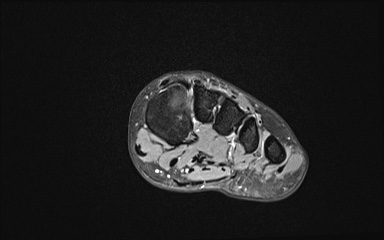 Bipartite hallux sesamoid diastasis (Radiopaedia 77133-89109 Coronal T2 fat sat 8).jpg