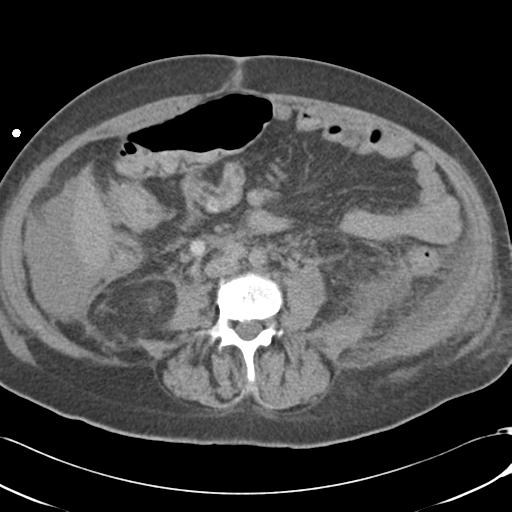 Bladder rupture post renal biopsy (Radiopaedia 30863-31572 Axial non-contrast 49).jpg