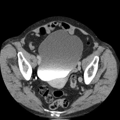 Bladder tumor detected on trauma CT (Radiopaedia 51809-57609 C 117).jpg