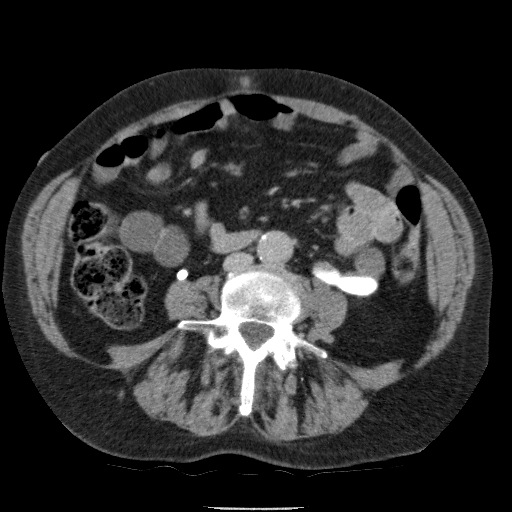 Bladder tumor detected on trauma CT (Radiopaedia 51809-57609 C 78).jpg