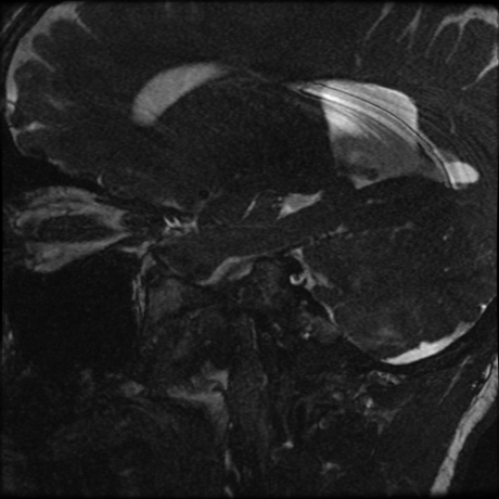 Blake's pouch cyst (Radiopaedia 75680-87010 Sagittal T2 2).jpg