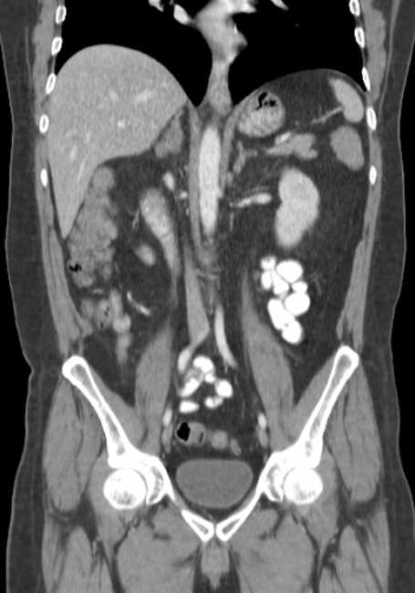 Bleeding duodenal ulcer and adenomyomatosis of gallbladder (Radiopaedia 61834-69861 B 40).jpg