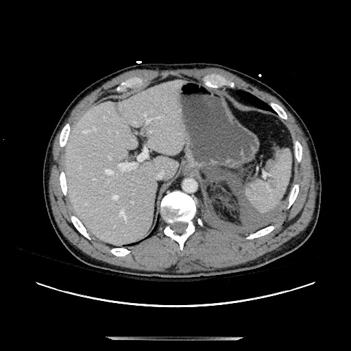 Blunt abdominal trauma with solid organ and musculoskelatal injury with active extravasation (Radiopaedia 68364-77895 A 27).jpg