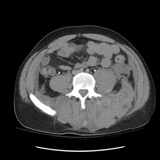 Blunt abdominal trauma with solid organ and musculoskelatal injury with active extravasation (Radiopaedia 68364-77895 Axial C+ delayed 87).jpg