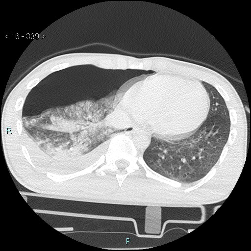 Blunt chest trauma (Swiss cheese sign) (Radiopaedia 38519-40618 Axial lung window 57).jpg