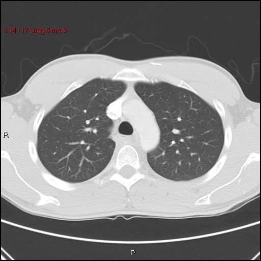 Blunt chest trauma - pulmonary interstitial emphysema and pneumomediastinum (Radiopaedia 20666-20552 Axial lung window 17).jpg