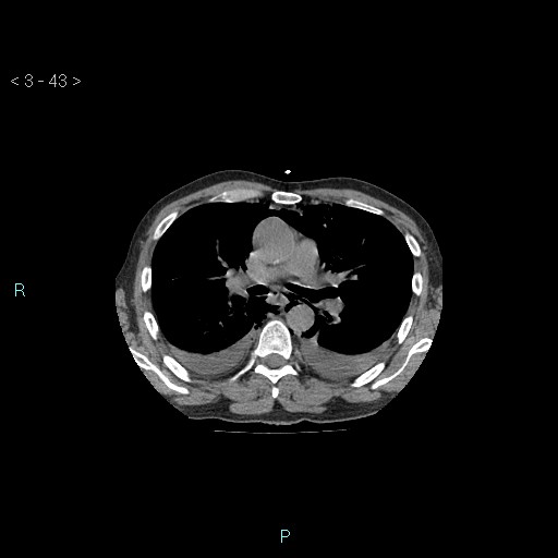Boerhaave syndrome (Radiopaedia 27683-27897 Axial non-contrast 43).jpg
