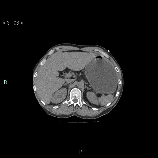 Boerhaave syndrome (Radiopaedia 27683-27897 Axial non-contrast 96).jpg