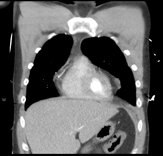 File:Boerhaave syndrome (Radiopaedia 39382-41661 B 16).png