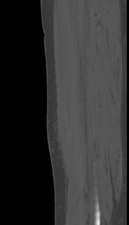 Bone metastasis - tibia (Radiopaedia 57665-64609 Sagittal bone window 137).jpg