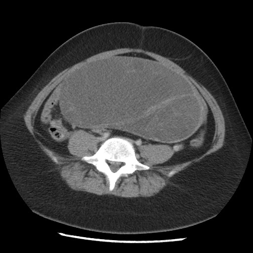 File:Borderline mucinous tumor (ovary) (Radiopaedia 78228-90808 A 106).jpg
