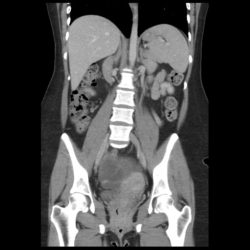 Borderline mucinous tumor (ovary) (Radiopaedia 78228-90808 C 31).jpg
