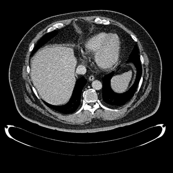 File:Bosniak renal cyst - type IV (Radiopaedia 24244-24518 C 18).jpg
