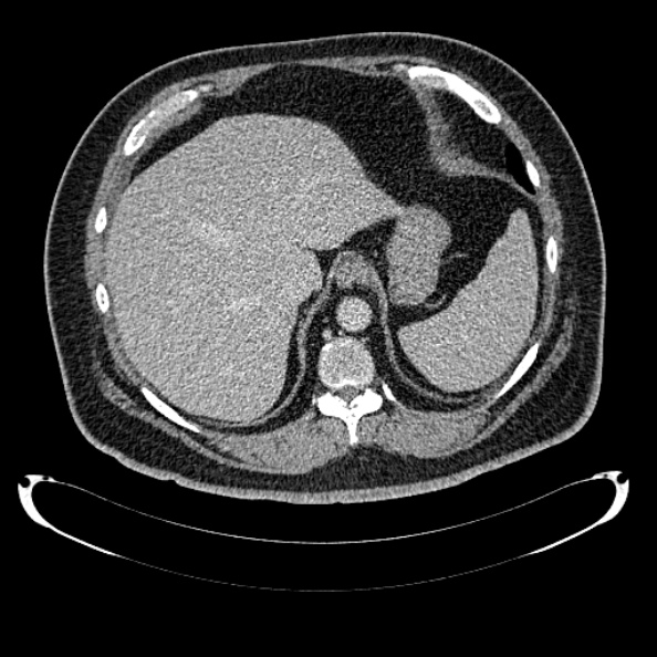 Bosniak renal cyst - type IV (Radiopaedia 24244-24518 C 44).jpg