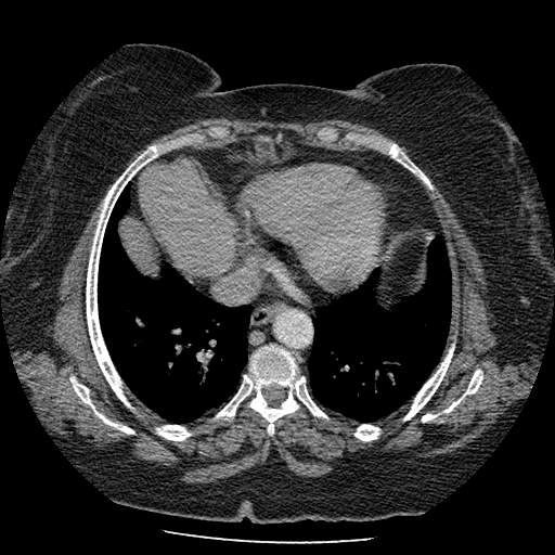 Bovine aortic arch - right internal mammary vein drains into the superior vena cava (Radiopaedia 63296-71875 A 112).jpg