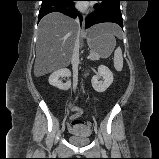 Bowel and splenic infarcts in acute lymphocytic leukemia (Radiopaedia 61055-68913 B 33).jpg