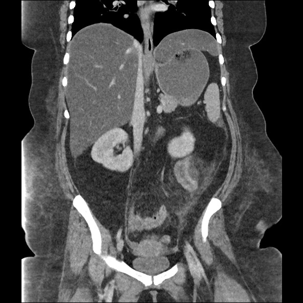 File:Bowel and splenic infarcts in acute lymphocytic leukemia (Radiopaedia 61055-68915 B 34).jpg
