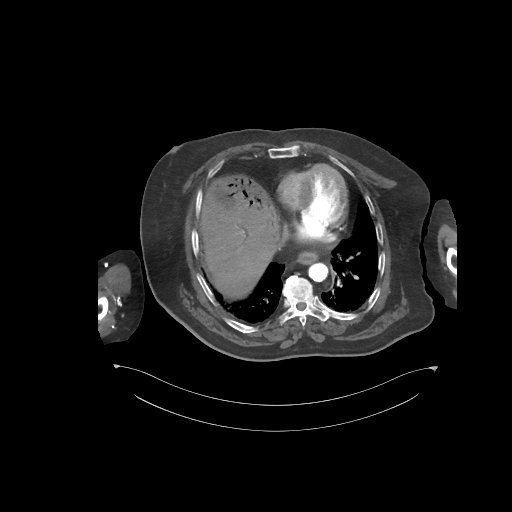 File:Bowel ischemia secondary to SMA occlusion with extensive portomesenteric venous gas (Radiopaedia 54656-60871 A 72).jpg
