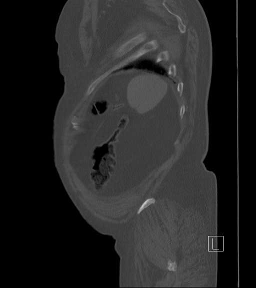 Bowel ischemia secondary to SMA occlusion with extensive portomesenteric venous gas (Radiopaedia 54656-60871 Sagittal bone window 12).jpg