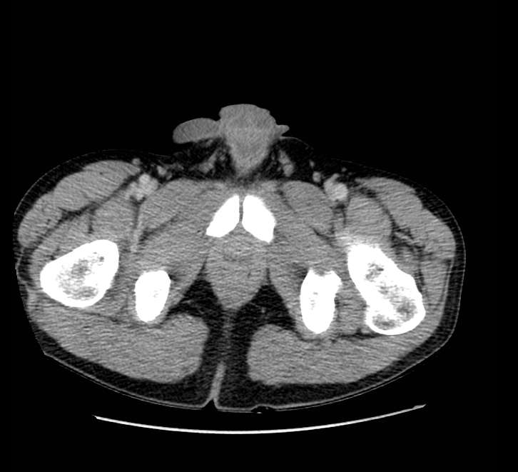 Bowel obstruction from colon carcinoma (Radiopaedia 22995-23028 A 89).jpg
