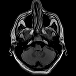File:Brain abscess complicated by intraventricular rupture and ventriculitis (Radiopaedia 82434-96571 Axial FLAIR 4).jpg