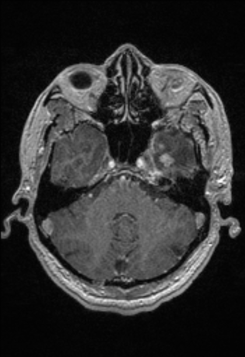 Brain abscess with ventriculitis (Radiopaedia 85703-101495 Axial T1 C+ 50).jpg