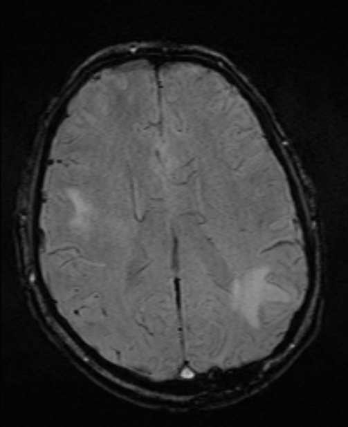 Brain metastases - lung cancer primary (Radiopaedia 75060-86115 Axial SWI 38).jpg