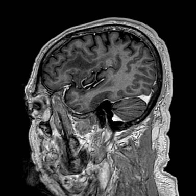 Brain metastases from lung cancer (Radiopaedia 83839-99028 Sagittal T1 C+ 12).jpg