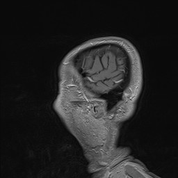 Brain metastasis (Radiopaedia 42617-45761 Sagittal T1 C+ 9).jpg