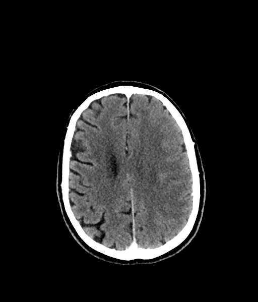Brain metastasis (large cystic mass) (Radiopaedia 47497-52106 Axial C+ 42).png
