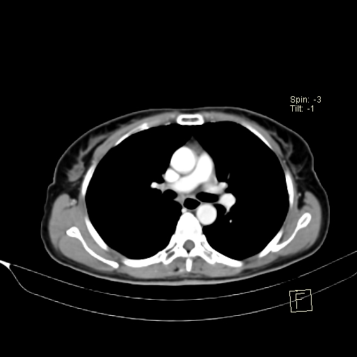 Brain metastasis as initial presentation of non-small cell lung cancer (Radiopaedia 65122-74127 A 21).jpg