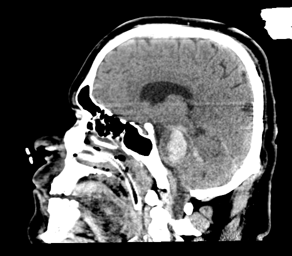 Brainstem hemorrhage (Radiopaedia 81294-94976 C 32).jpg