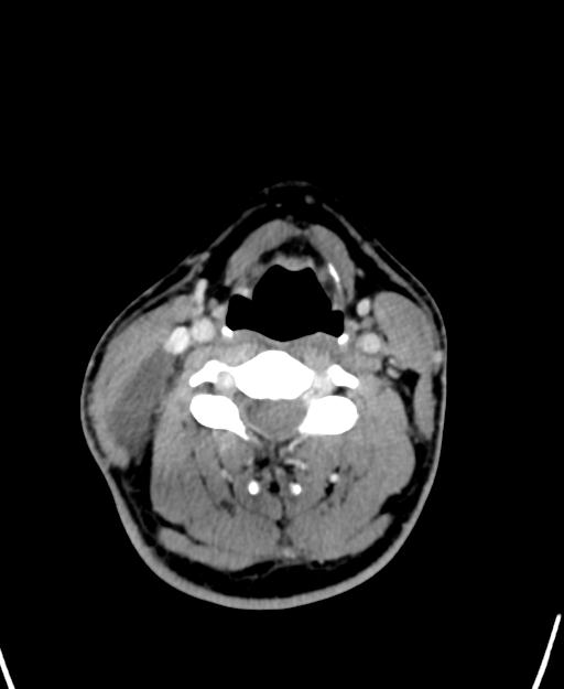 Branchial cleft cyst (Radiopaedia 31167-31875 Axial C+ delayed 35).jpg