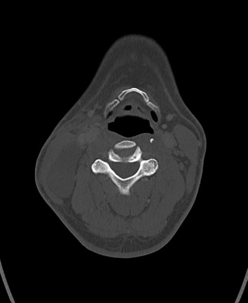Branchial cleft cyst (Radiopaedia 31167-31875 Axial bone window 37).jpg