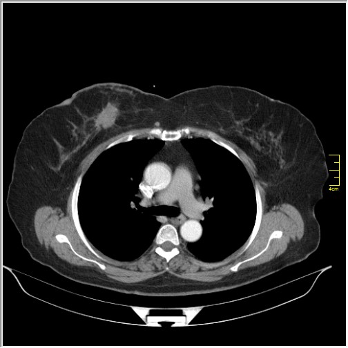 File:Breast cancer on thorax CT (Radiopaedia 60571-68275 A 39).JPG