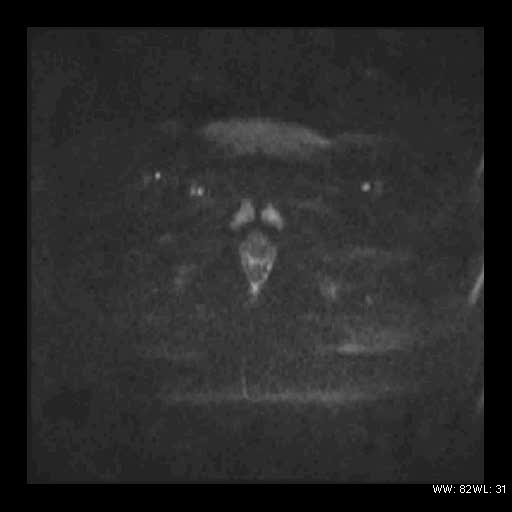 File:Broad ligament fibroid (Radiopaedia 49135-54241 Axial DWI 25).jpg