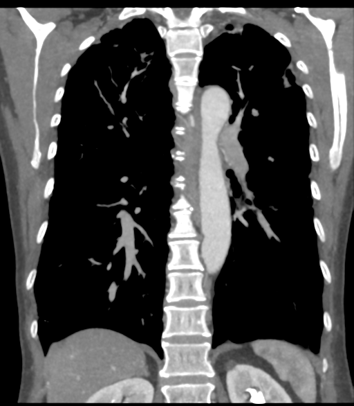 Bronchial artery aneurysms (Radiopaedia 42282-45385 Coronal C+ delayed 44).png