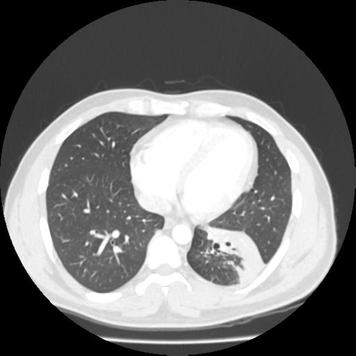 File:Bronchial carcinoid (Radiopaedia 80013-93291 Axial lung window 87).jpg