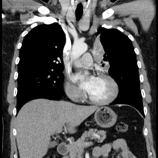 Bronchial carcinoid tumor (Radiopaedia 67377-76764 C 32).jpg